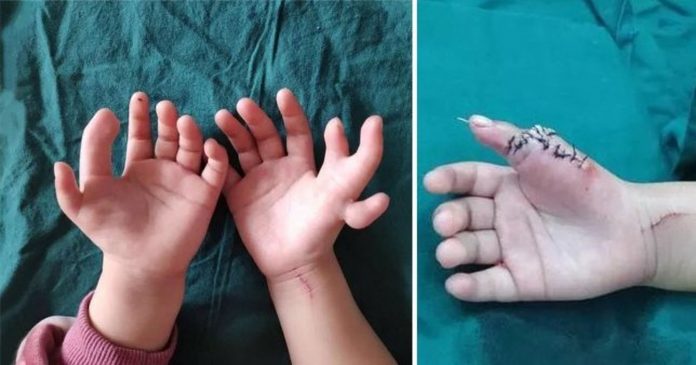 Djevojčica rođena s 14 prstiju je imala operaciju koja joj je promijenila život