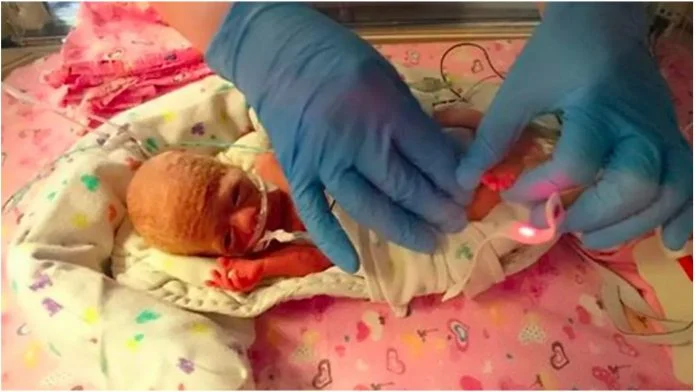Novorođenče je imalo pola kilograma, liječnik mu je spasio život