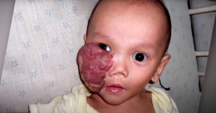 Dijete s tumorom na licu su dali na posvajanje, a nakon nekoliko godina uslijedilo je čudo