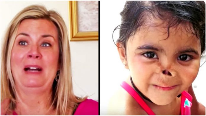 Žena je usvojila djevojčicu kojoj su životinje pojele nos, a sada izgleda neprepoznatljivo
