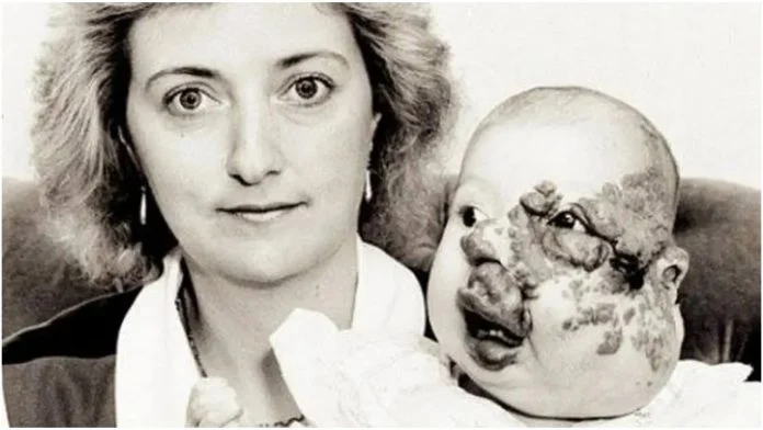 Djevojčica rođena s deformiranim licem je danas zdrava žena i majka