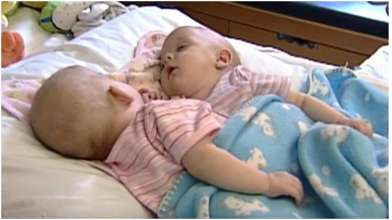 Rođene su kao sijamske blizanke: Kako danas izgledaju, pravo je Božje čudo