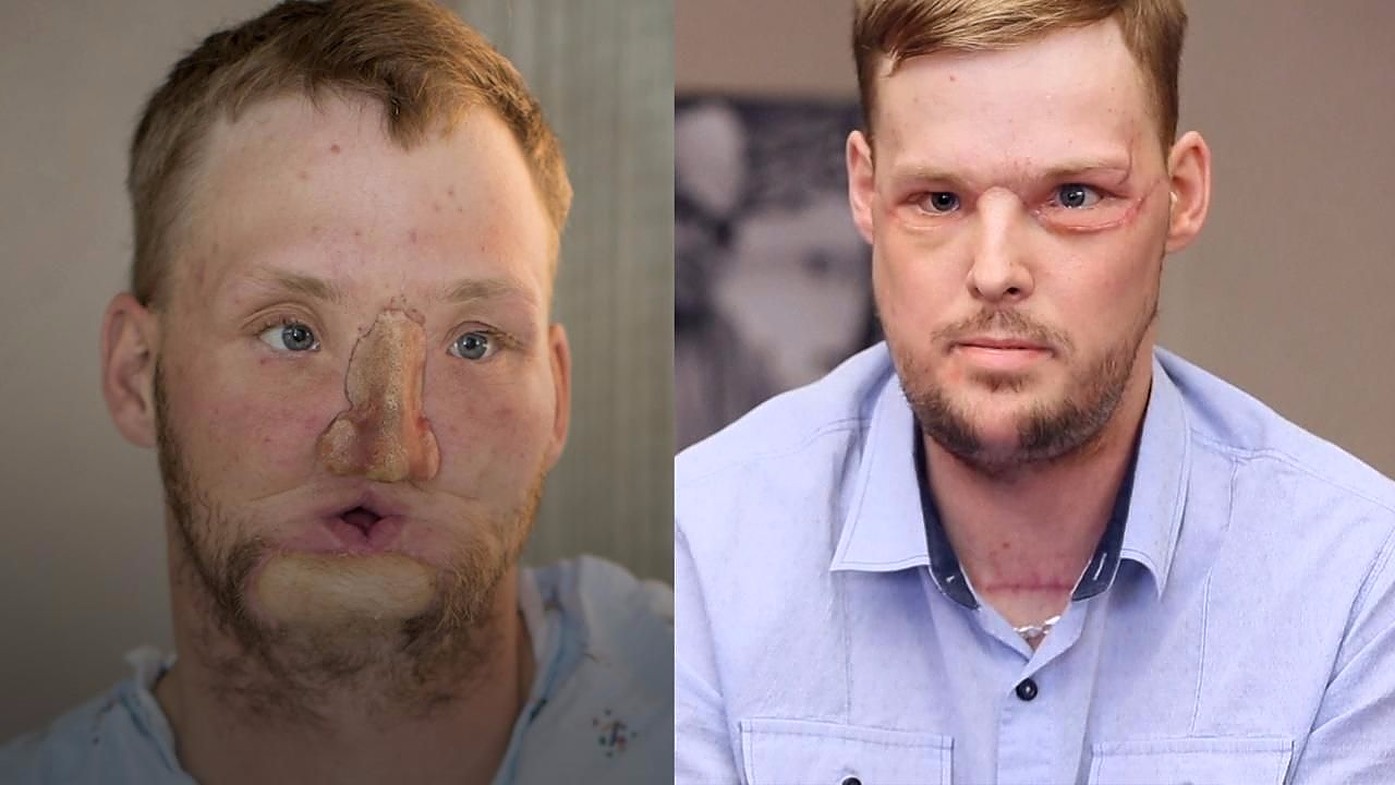 Mladić (21) prošao kroz nevjerojatnu operaciju transplantacije lica