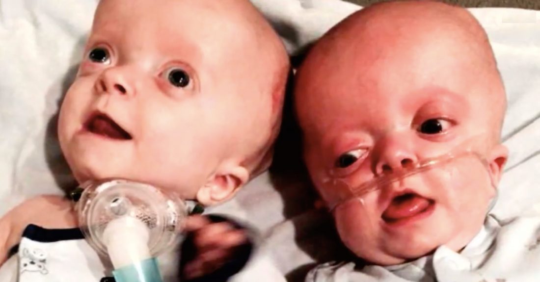 Deformirani blizanci su ostavljeni u bolnici bez roditelja – medicinska ih je sestra povela kući
